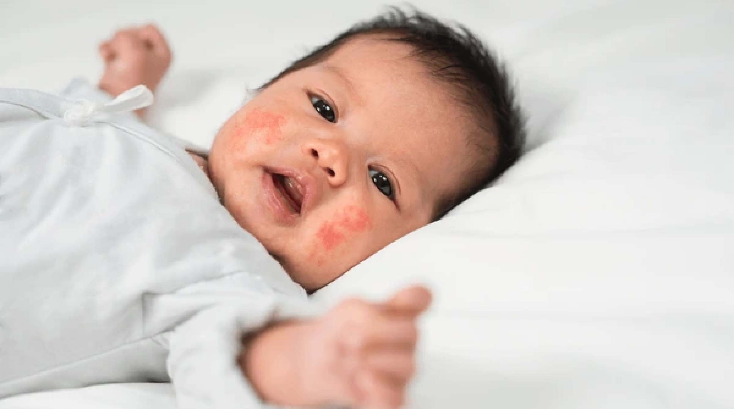 Baby Heat Rash
